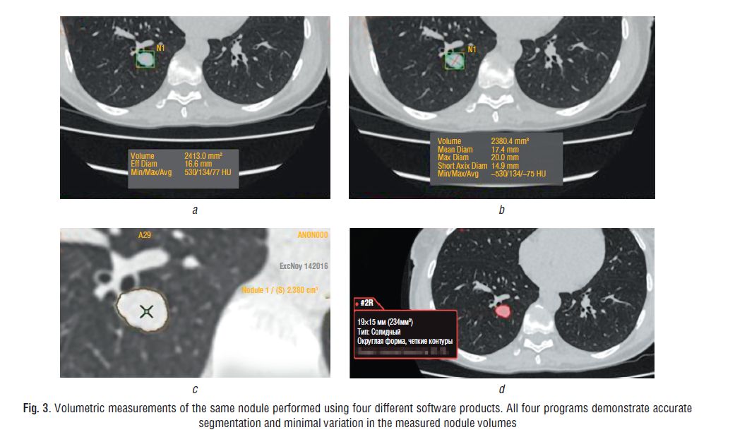 Automated Lung Nodule Measurement: How Hiveomics Compares to Industry Solutions