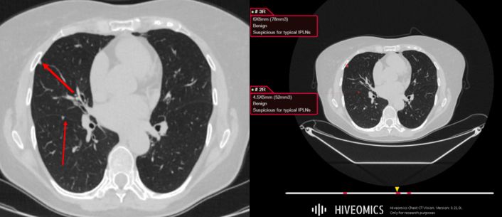 Intelligence That Sees More: How We Built an AI Model for Automatic Intrapulmonary Lymph Node Classification